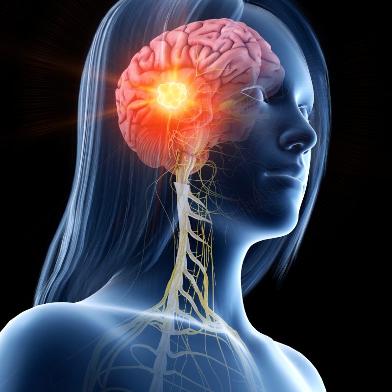 3d rendered medically accurate illustration of brain cancer