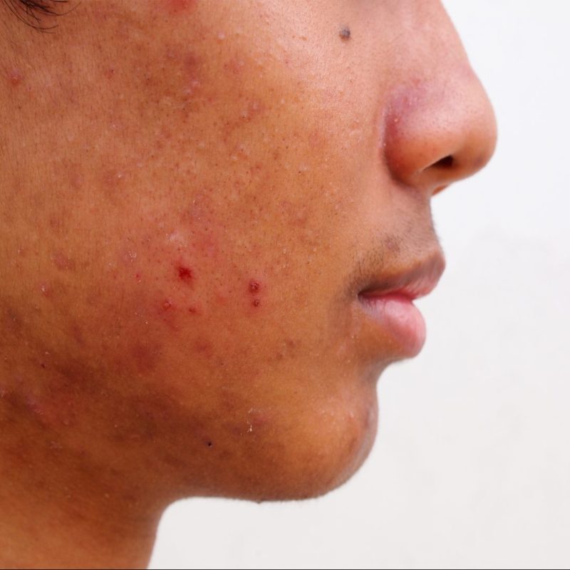 Image before and after acne treatment on the face of young Asian men. Problem skin and beauty concept.